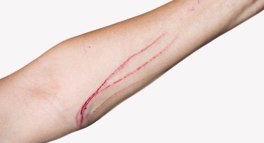 Cat nail scratch